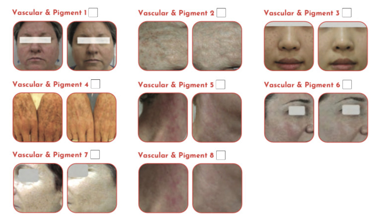 Vascular---Pigmented-Lesions-before-after